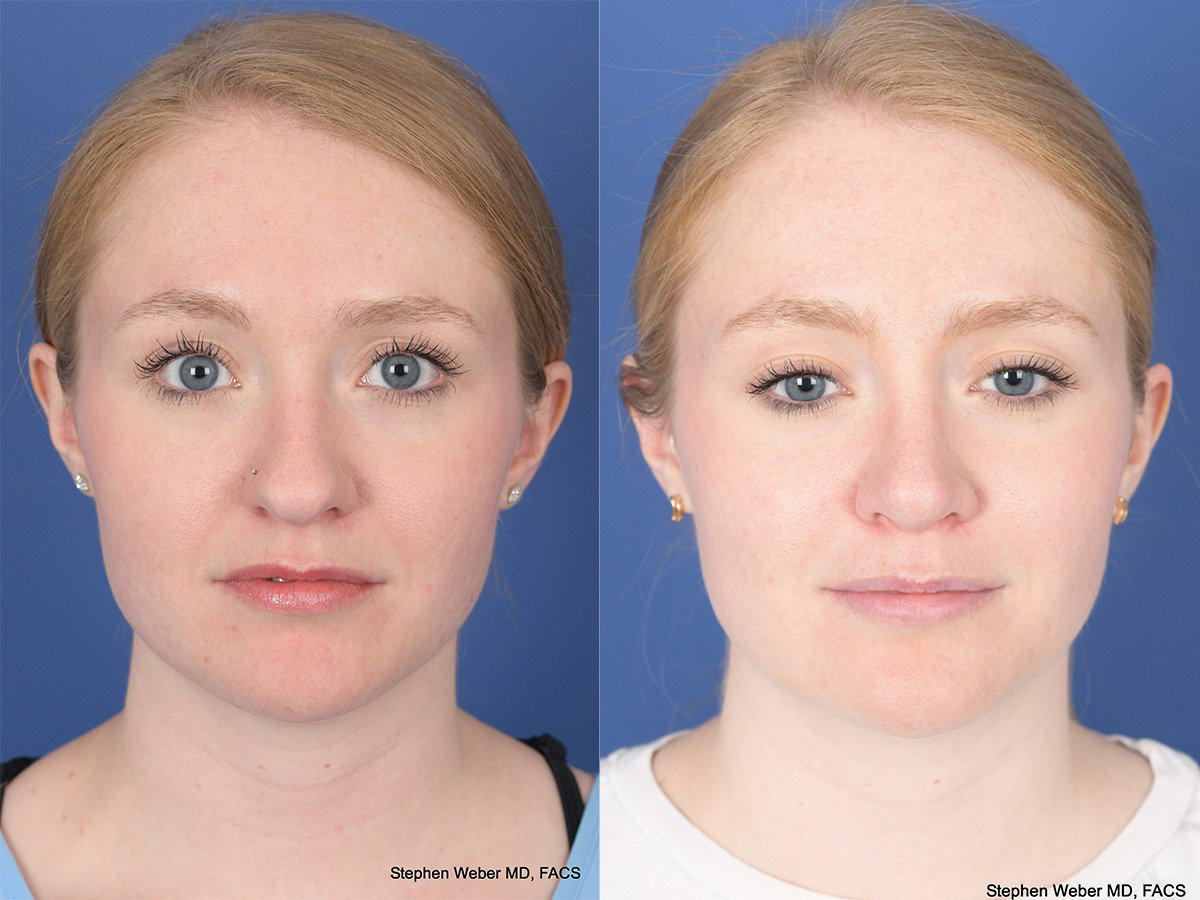 Rhinoplasty Before and After | Weber Facial Plastic Surgery