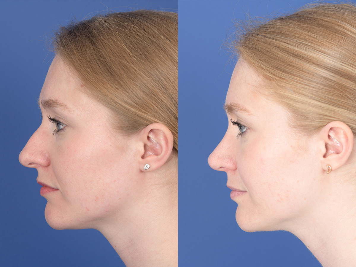 Rhinoplasty Before and After | Weber Facial Plastic Surgery