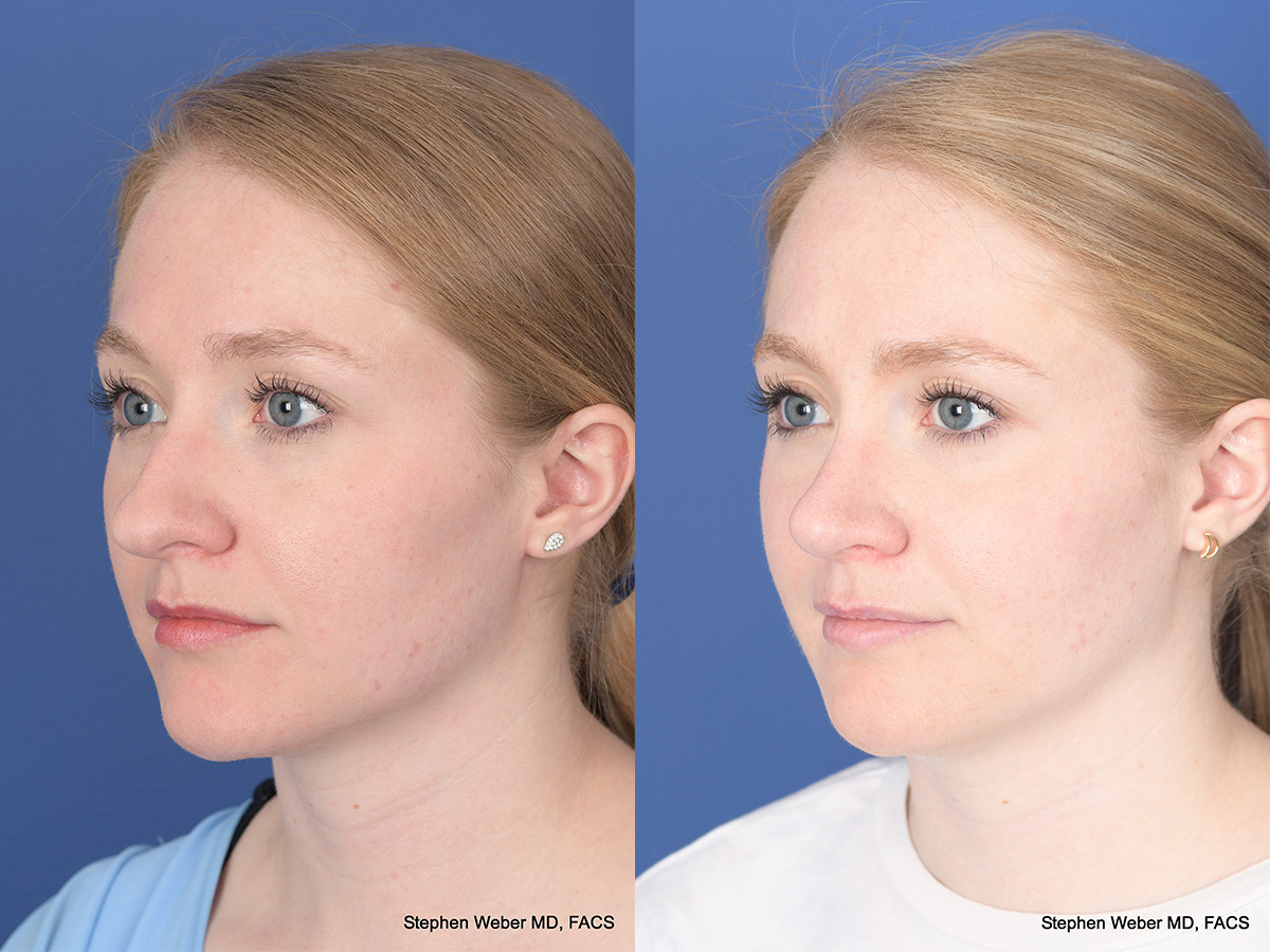 Rhinoplasty Before and After | Weber Facial Plastic Surgery