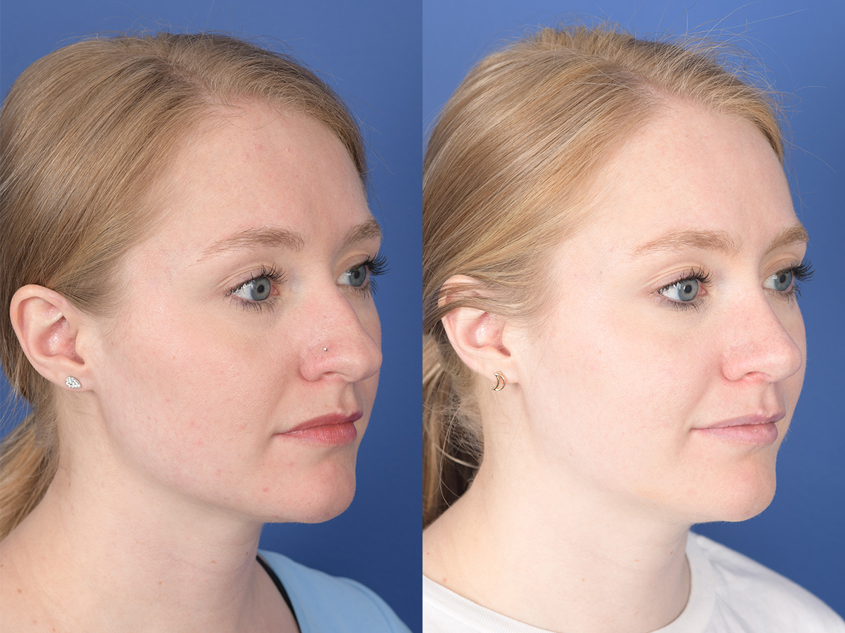 Rhinoplasty Before and After | Weber Facial Plastic Surgery