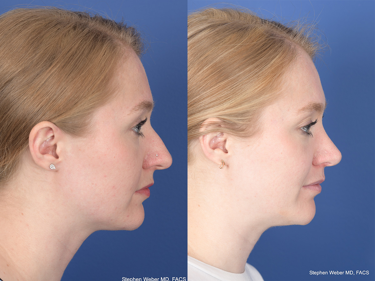Rhinoplasty Before and After | Weber Facial Plastic Surgery