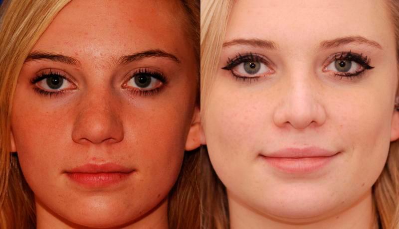 Rhinoplasty Before and After | Weber Facial Plastic Surgery