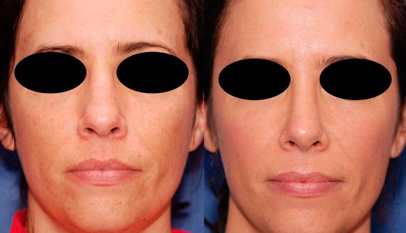 Rhinoplasty Before and After | Weber Facial Plastic Surgery