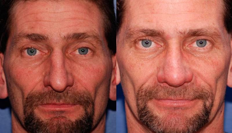 Rhinoplasty Before and After | Weber Facial Plastic Surgery
