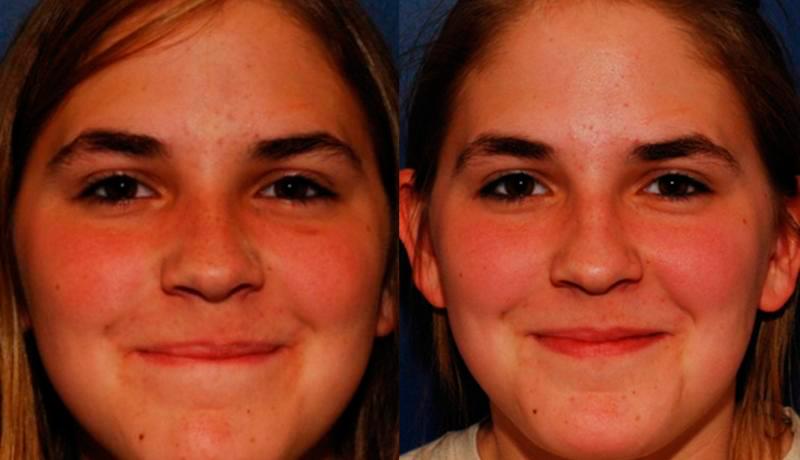 Rhinoplasty Before and After | Weber Facial Plastic Surgery