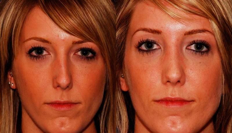 Rhinoplasty Before and After | Weber Facial Plastic Surgery