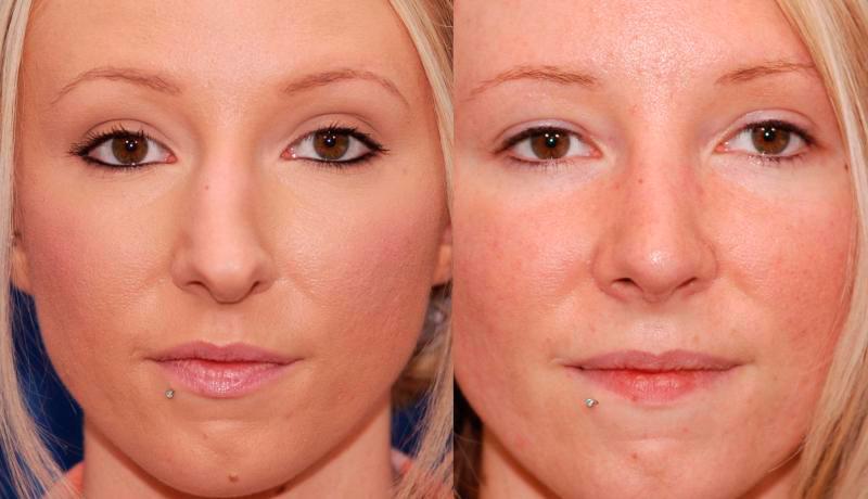 Rhinoplasty Before and After | Weber Facial Plastic Surgery
