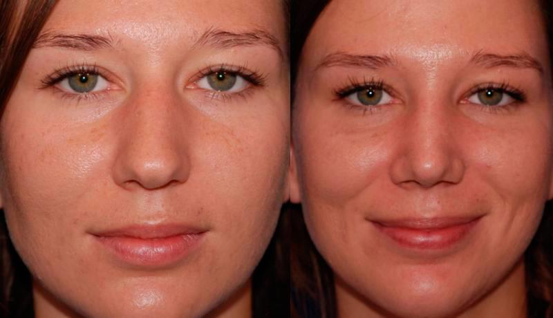 Rhinoplasty Before and After | Weber Facial Plastic Surgery