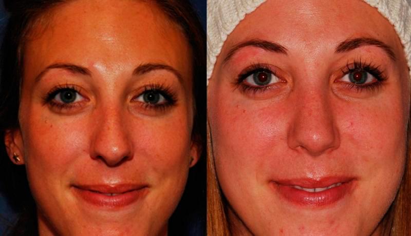 Rhinoplasty Before and After | Weber Facial Plastic Surgery
