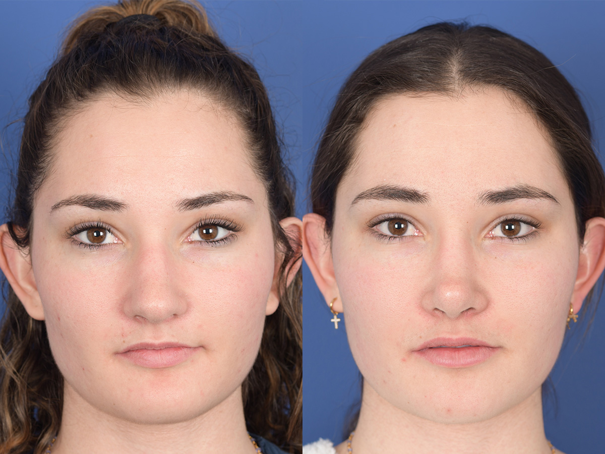Rhinoplasty Before and After | Weber Facial Plastic Surgery