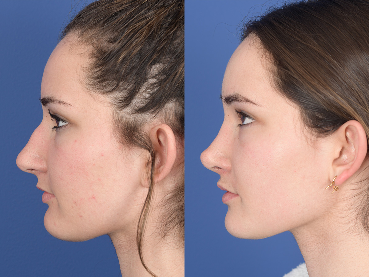 Rhinoplasty Before and After | Weber Facial Plastic Surgery