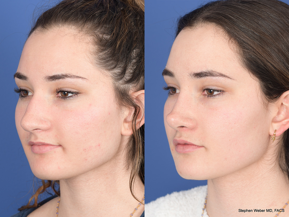 Rhinoplasty Before and After | Weber Facial Plastic Surgery