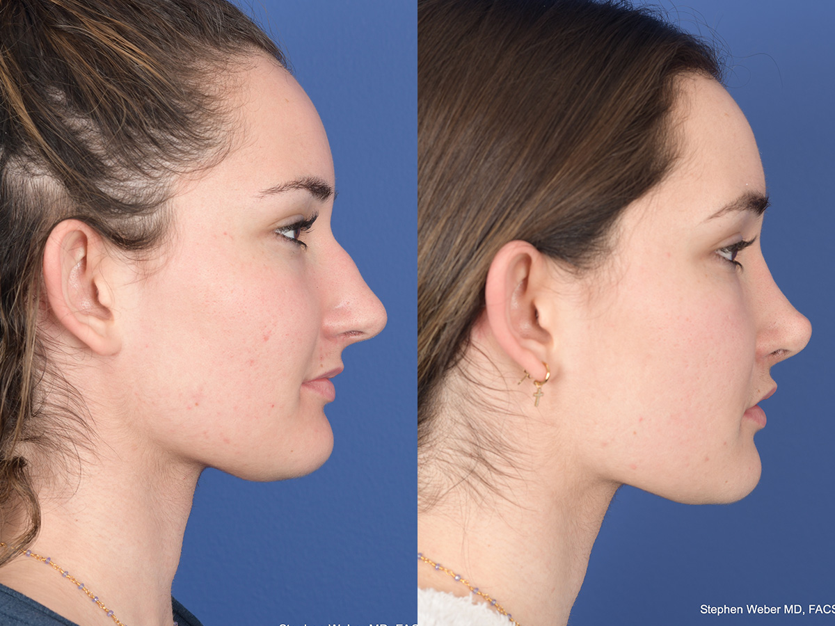 Rhinoplasty Before and After | Weber Facial Plastic Surgery