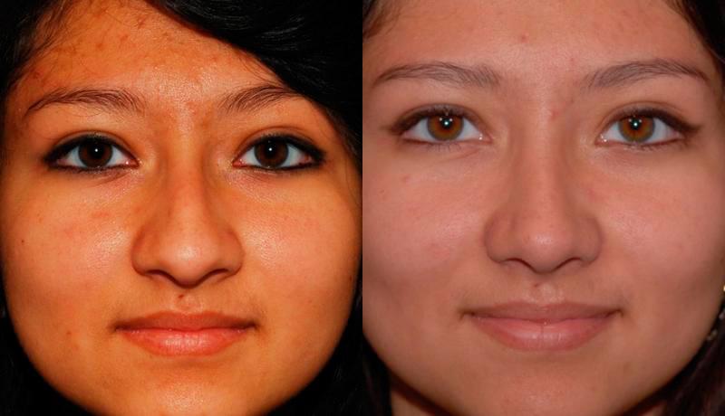 Rhinoplasty Before and After | Weber Facial Plastic Surgery
