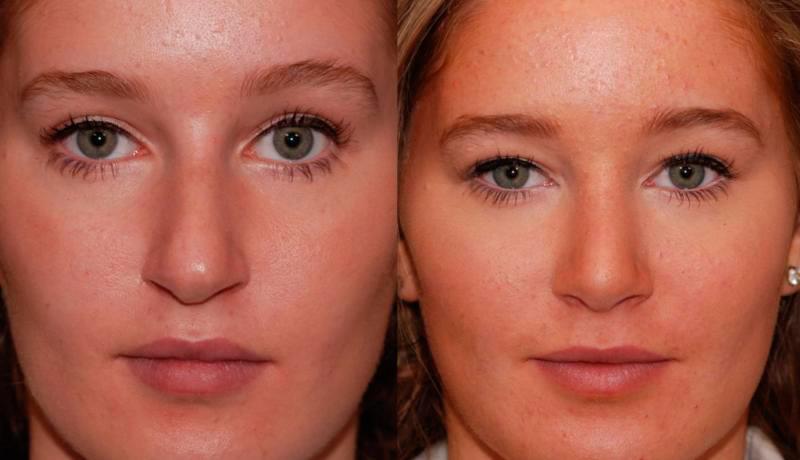 Rhinoplasty Before and After | Weber Facial Plastic Surgery