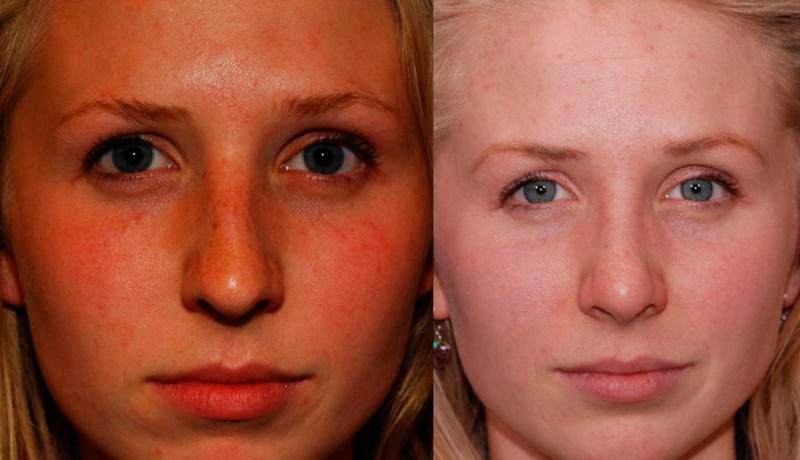 Rhinoplasty Before and After | Weber Facial Plastic Surgery