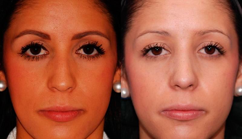 Rhinoplasty Before and After | Weber Facial Plastic Surgery