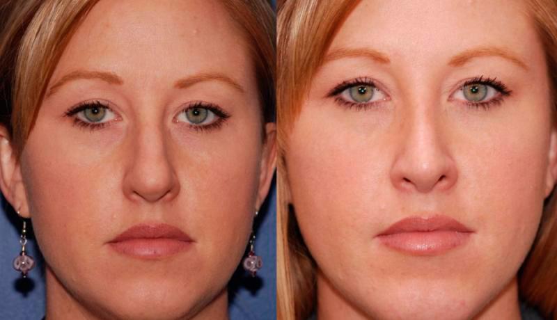 Rhinoplasty Before and After | Weber Facial Plastic Surgery