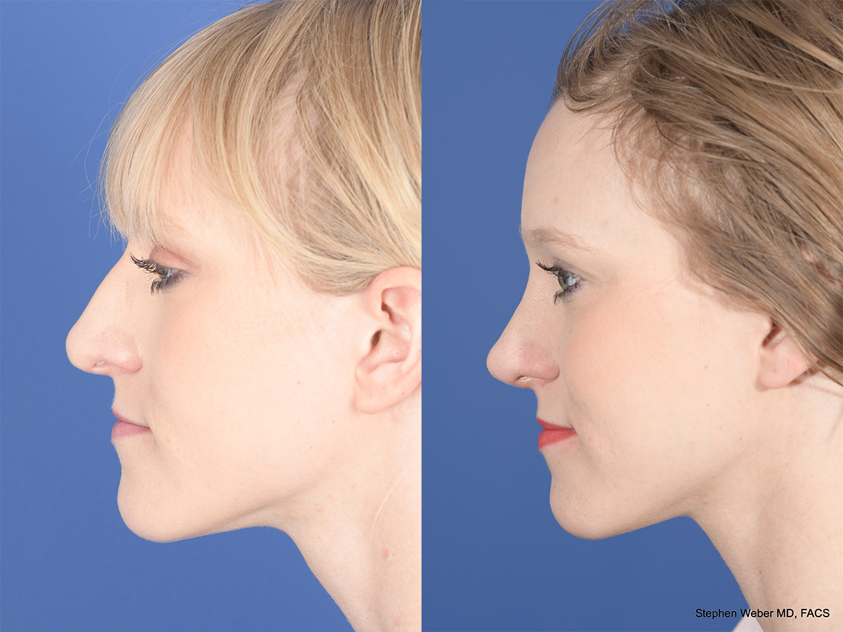 Rhinoplasty Before and After | Weber Facial Plastic Surgery