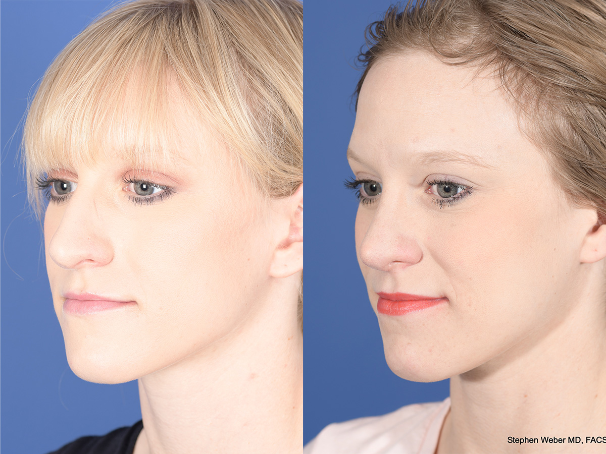 Rhinoplasty Before and After | Weber Facial Plastic Surgery
