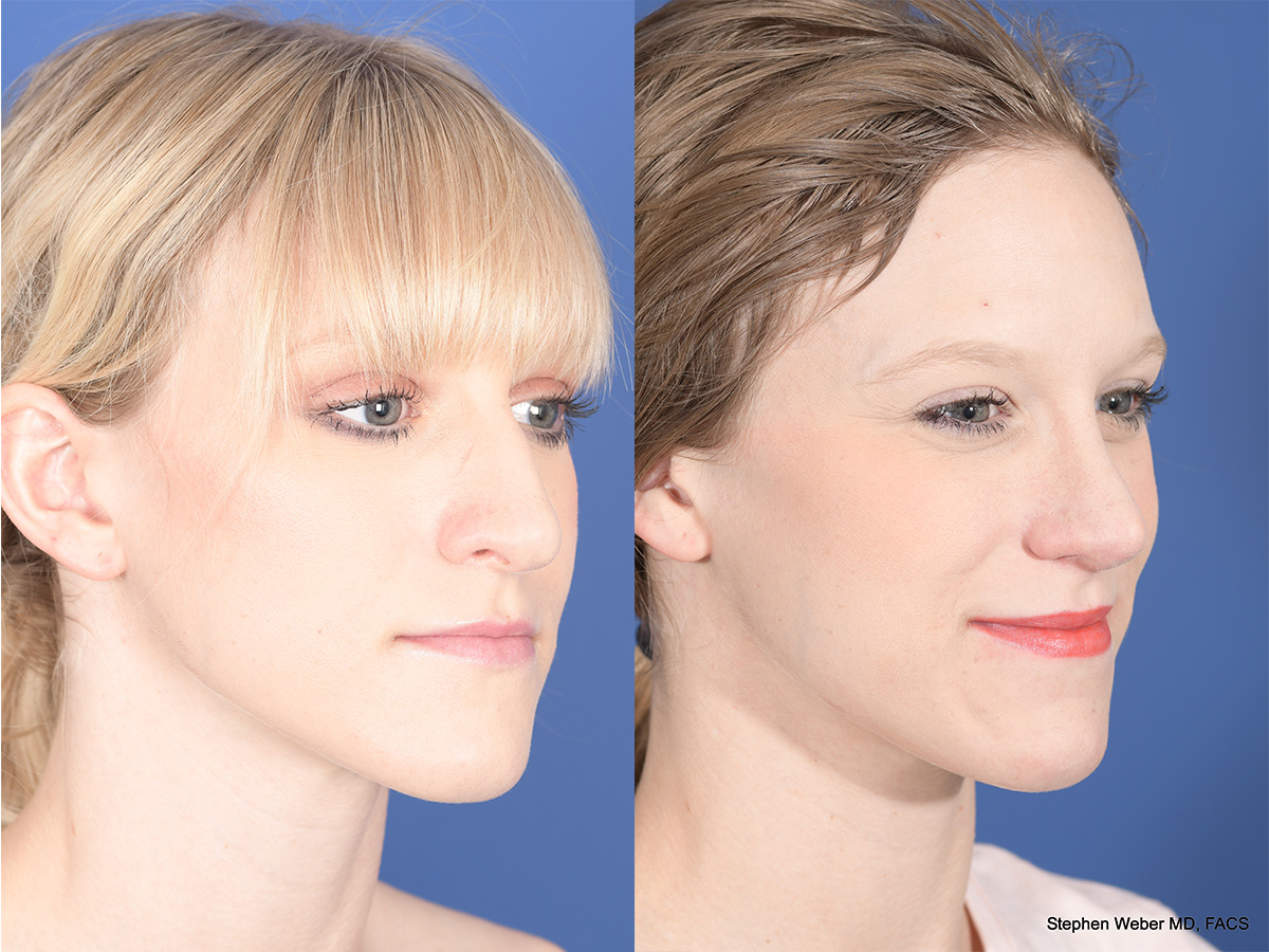 Rhinoplasty Before and After | Weber Facial Plastic Surgery