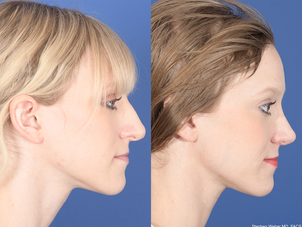 Rhinoplasty Before and After | Weber Facial Plastic Surgery