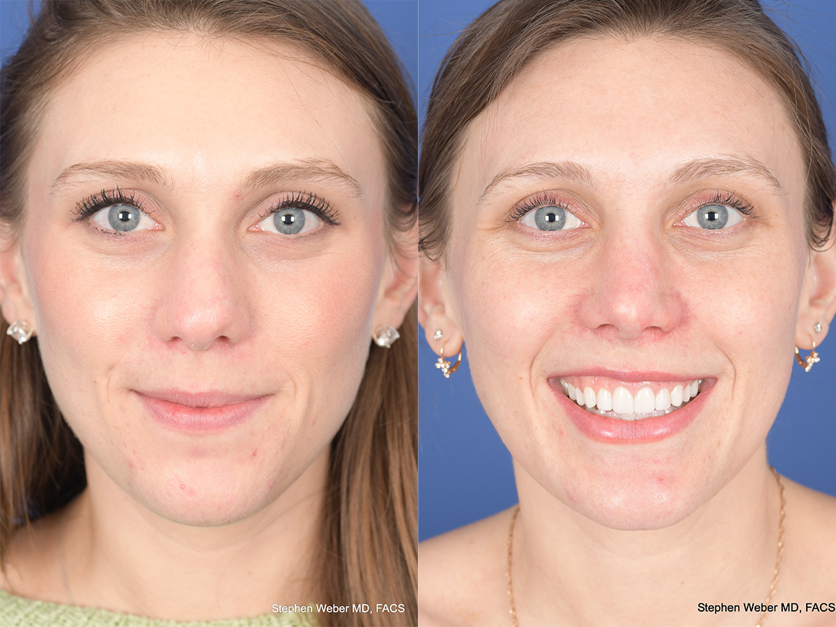 Rhinoplasty Before and After | Weber Facial Plastic Surgery