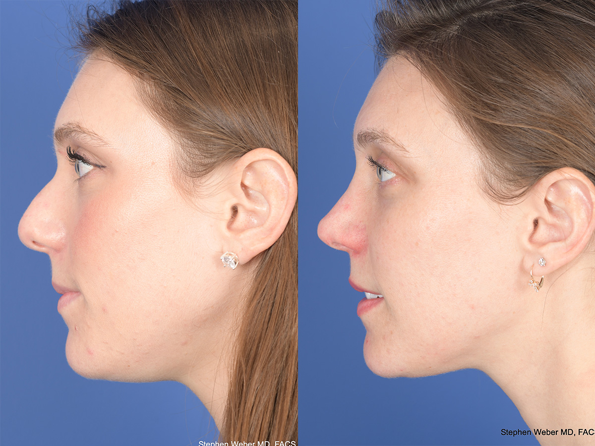 Rhinoplasty Before and After | Weber Facial Plastic Surgery