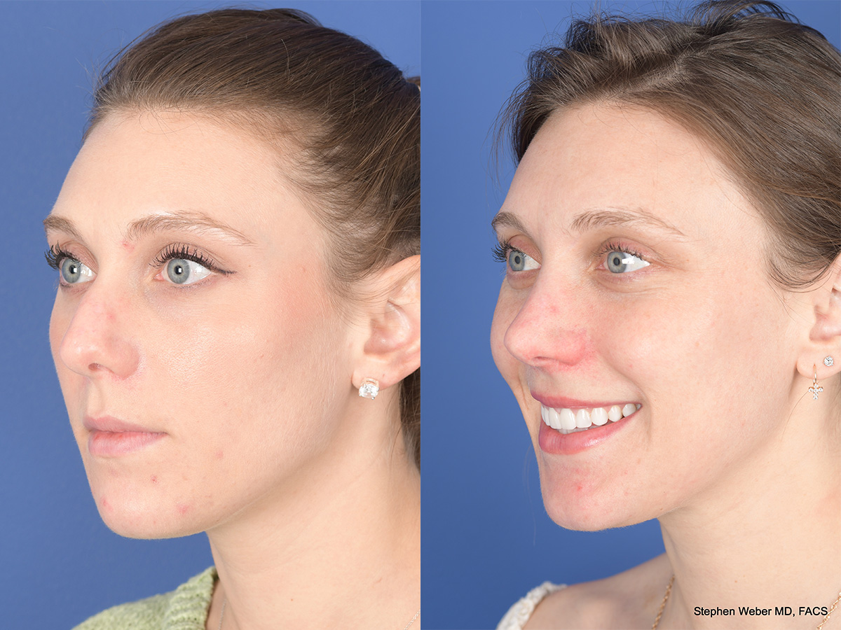 Rhinoplasty Before and After | Weber Facial Plastic Surgery