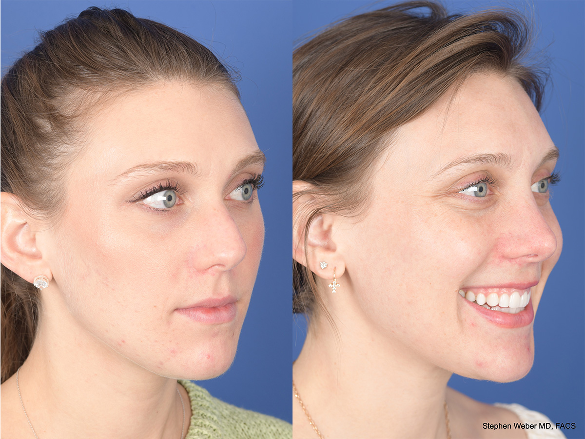 Rhinoplasty Before and After | Weber Facial Plastic Surgery