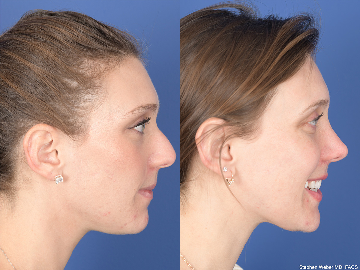 Rhinoplasty Before and After | Weber Facial Plastic Surgery