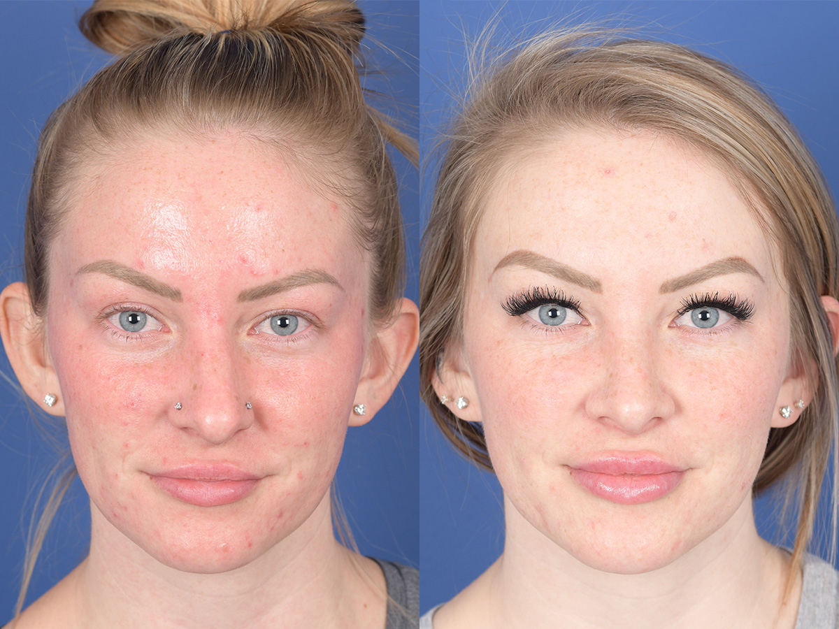 Rhinoplasty Before and After | Weber Facial Plastic Surgery