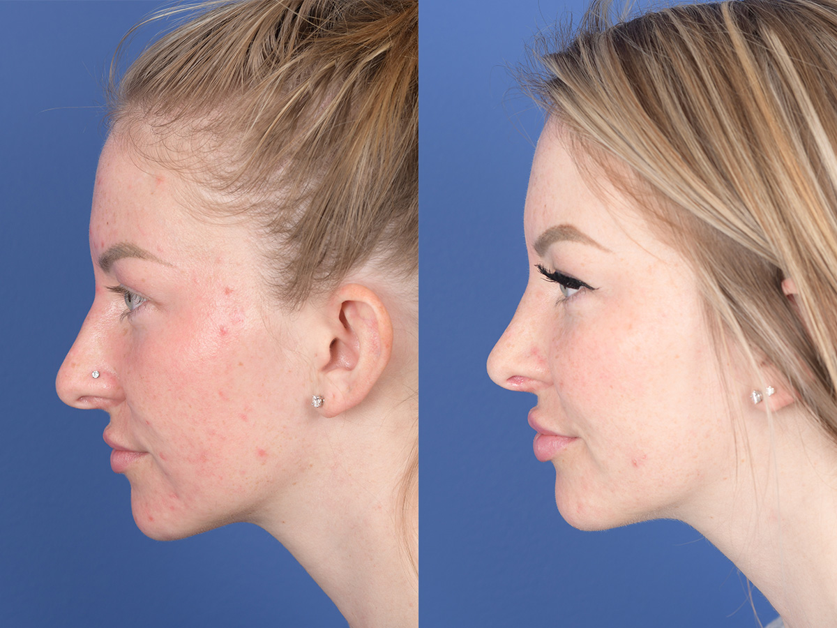 Rhinoplasty Before and After | Weber Facial Plastic Surgery