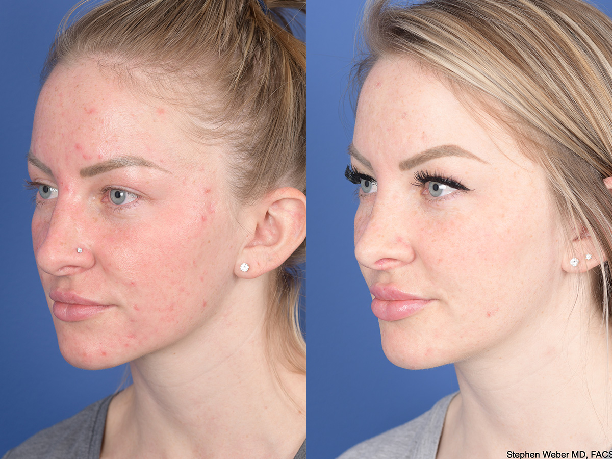 Rhinoplasty Before and After | Weber Facial Plastic Surgery