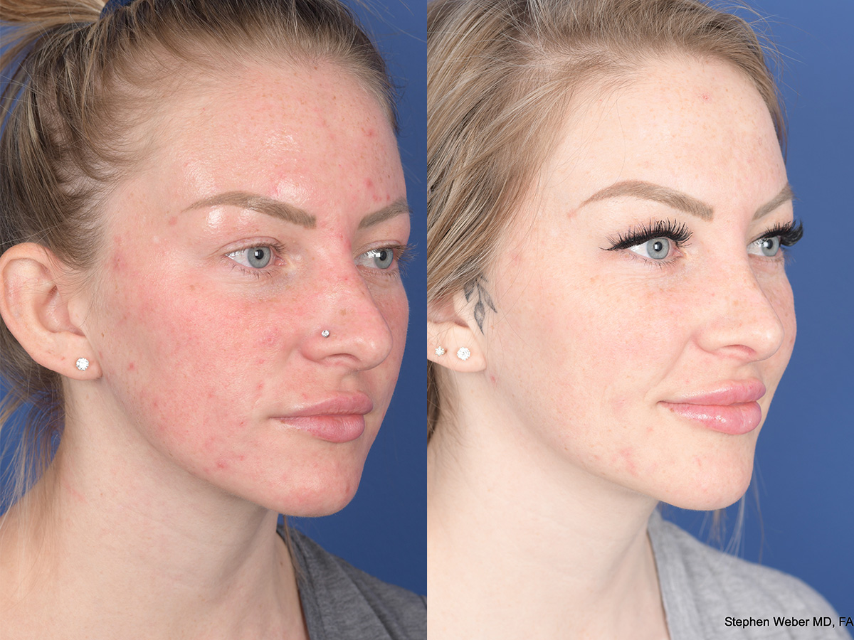 Rhinoplasty Before and After | Weber Facial Plastic Surgery