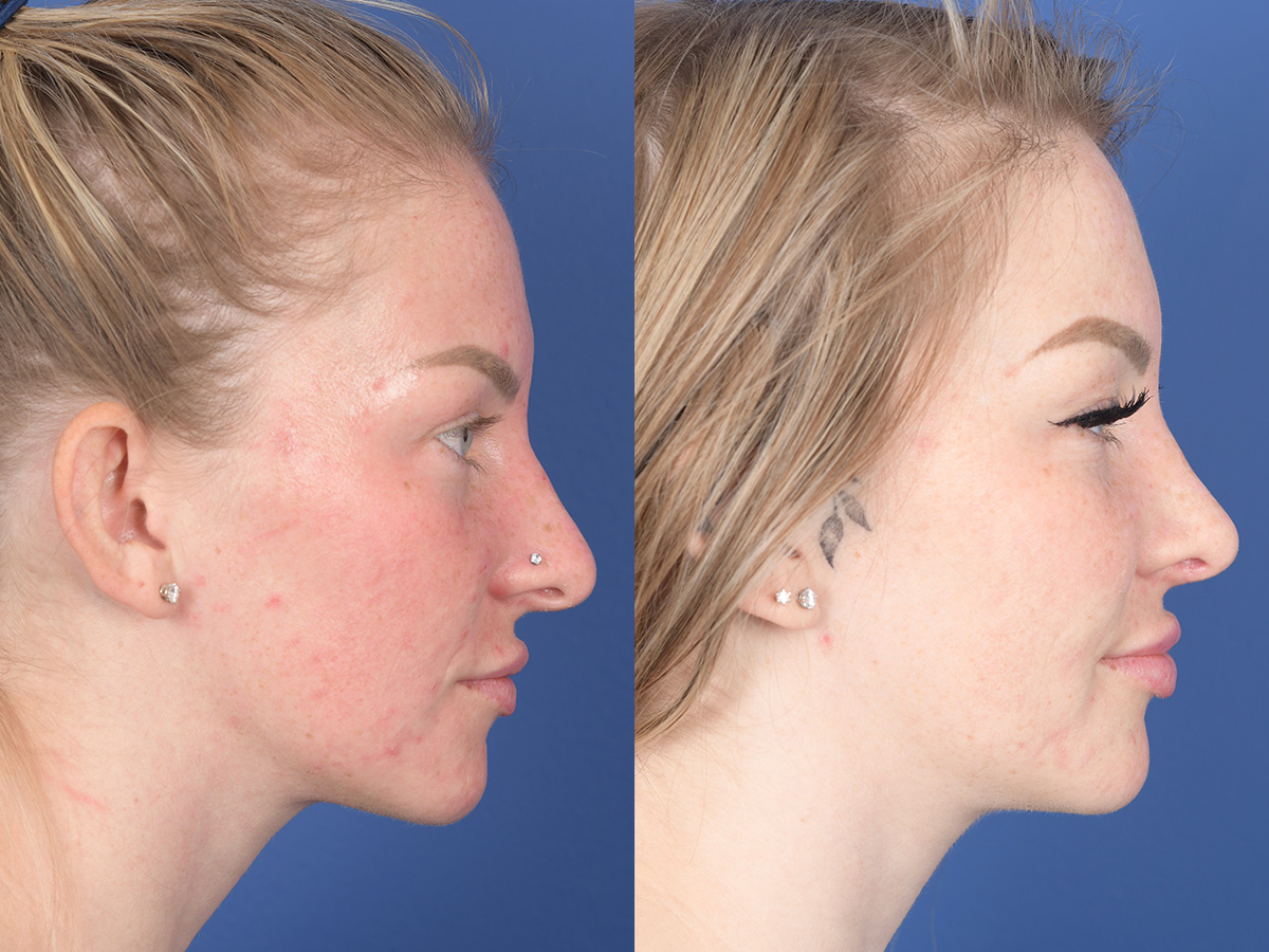 Rhinoplasty Before and After | Weber Facial Plastic Surgery