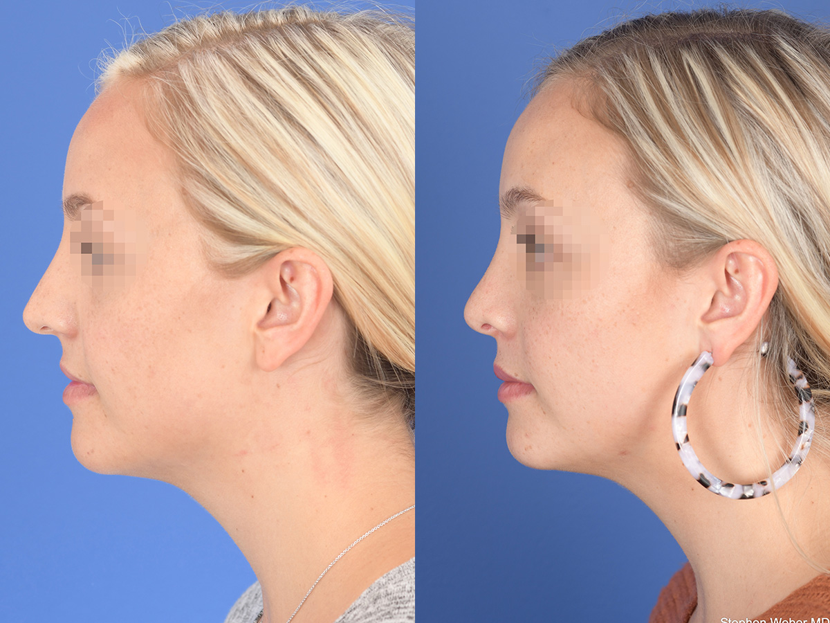 Rhinoplasty Before and After | Weber Facial Plastic Surgery