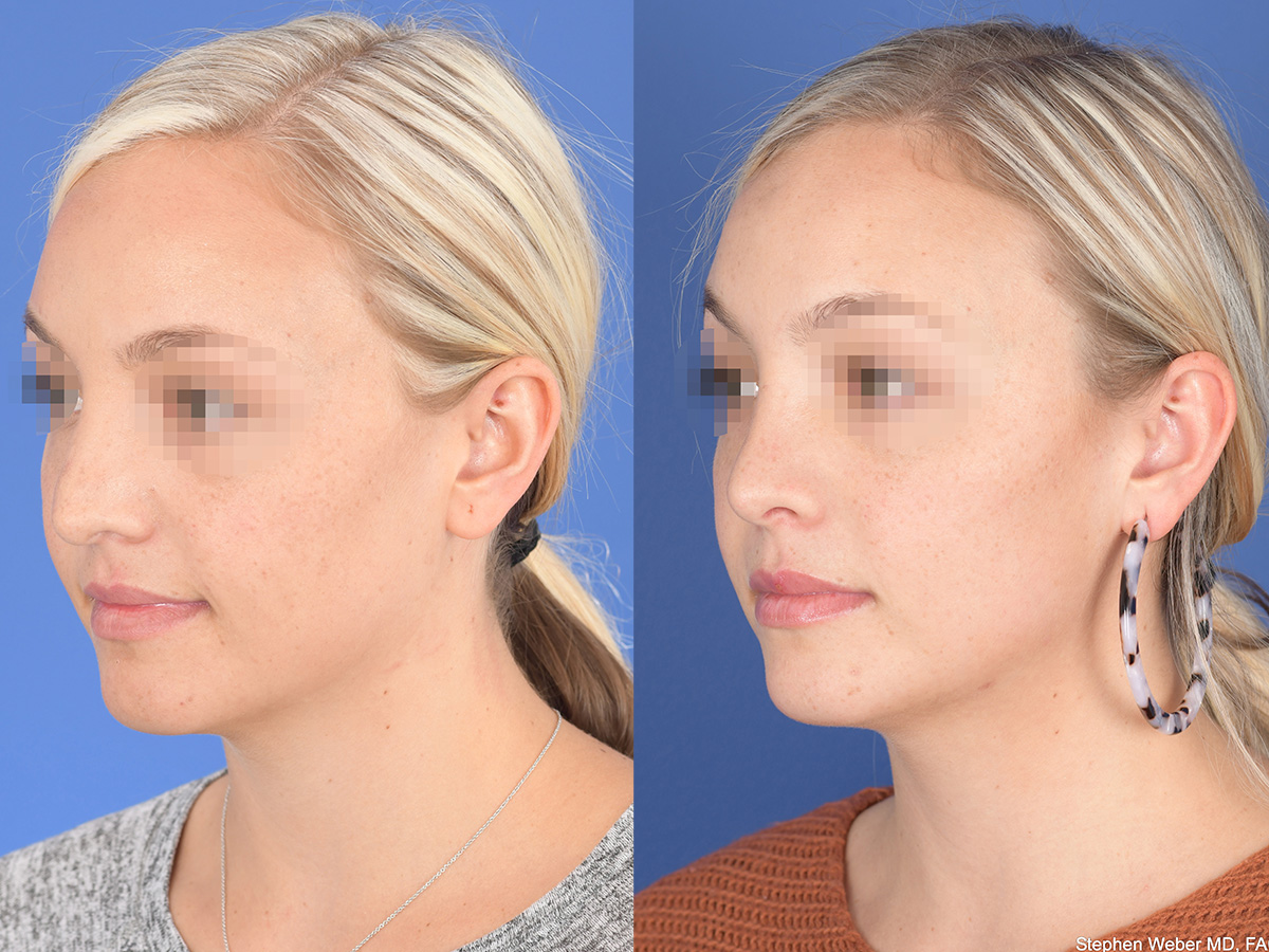 Rhinoplasty Before and After | Weber Facial Plastic Surgery