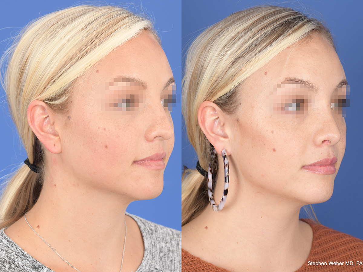 Rhinoplasty Before and After | Weber Facial Plastic Surgery