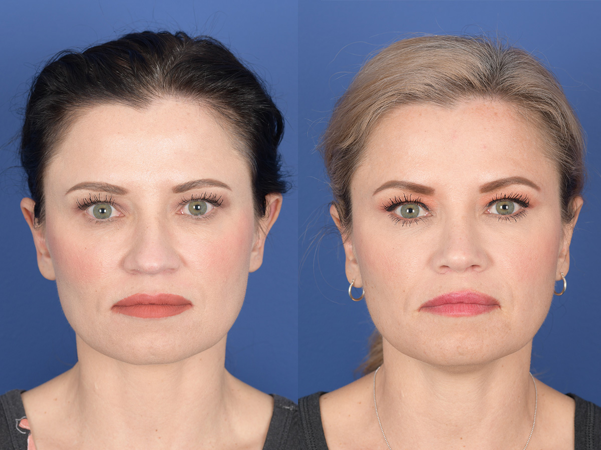 Rhinoplasty Before and After | Weber Facial Plastic Surgery