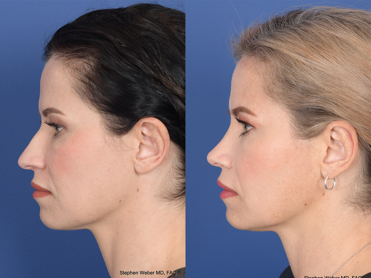 Rhinoplasty Before and After | Weber Facial Plastic Surgery