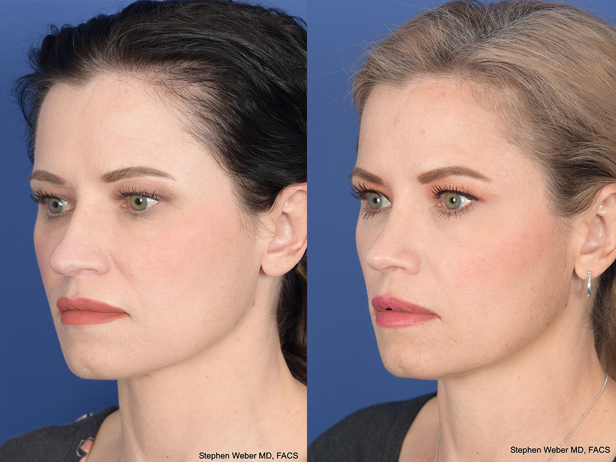 Rhinoplasty Before and After | Weber Facial Plastic Surgery