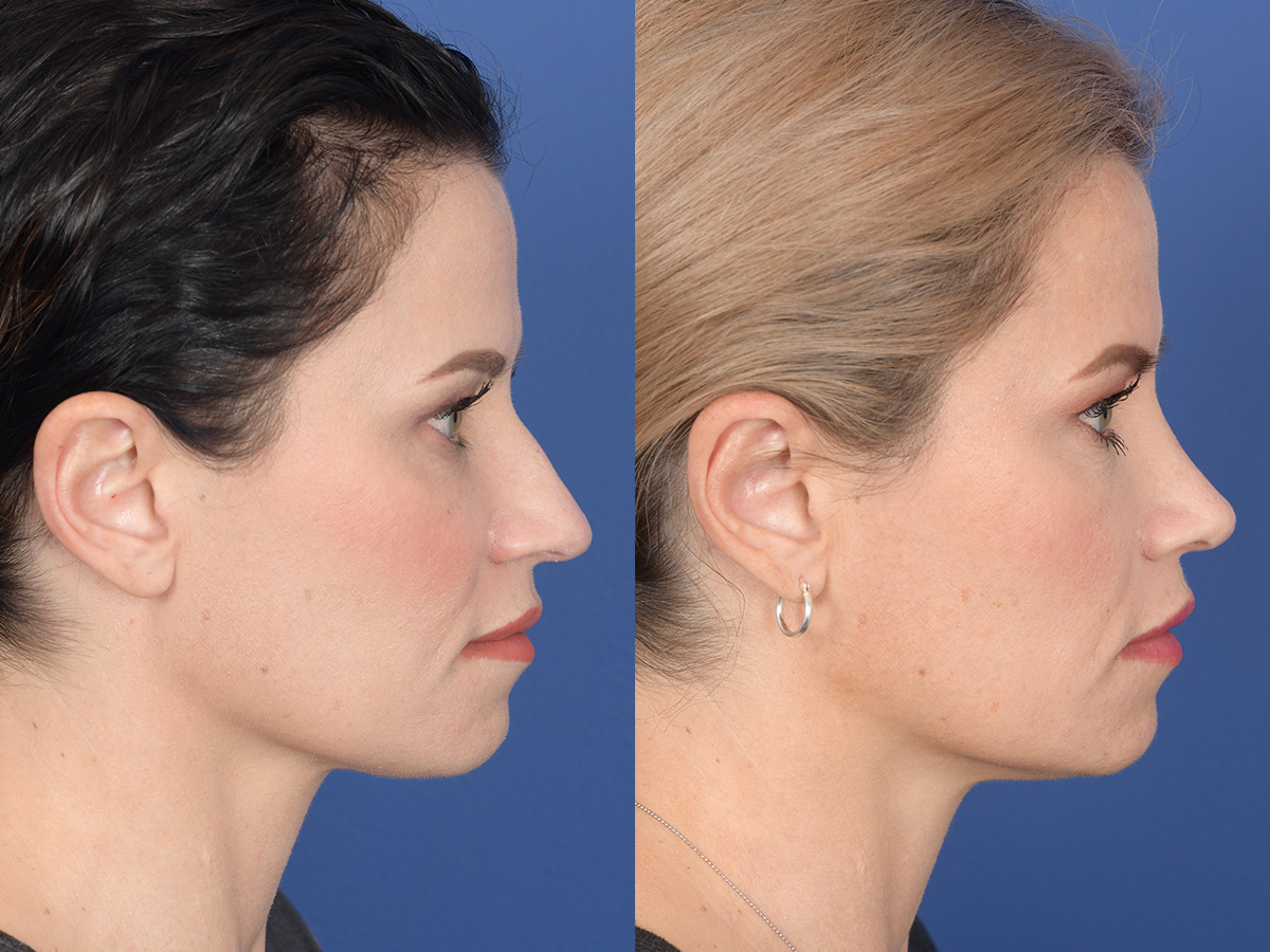 Rhinoplasty Before and After | Weber Facial Plastic Surgery