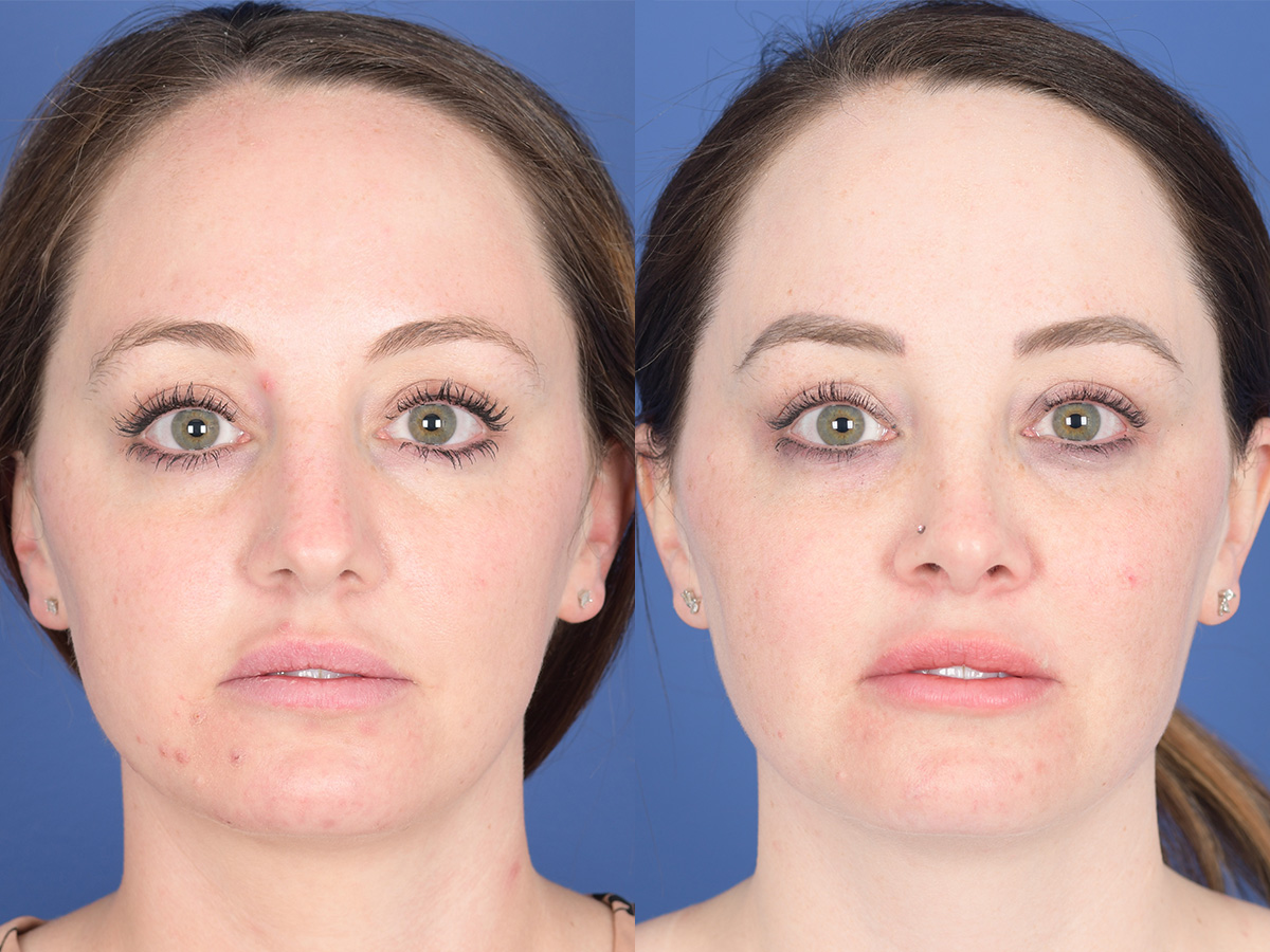 Rhinoplasty Before and After | Weber Facial Plastic Surgery