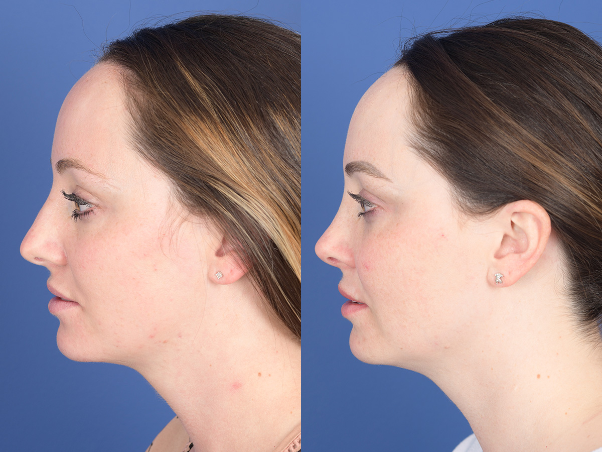 Rhinoplasty Before and After | Weber Facial Plastic Surgery