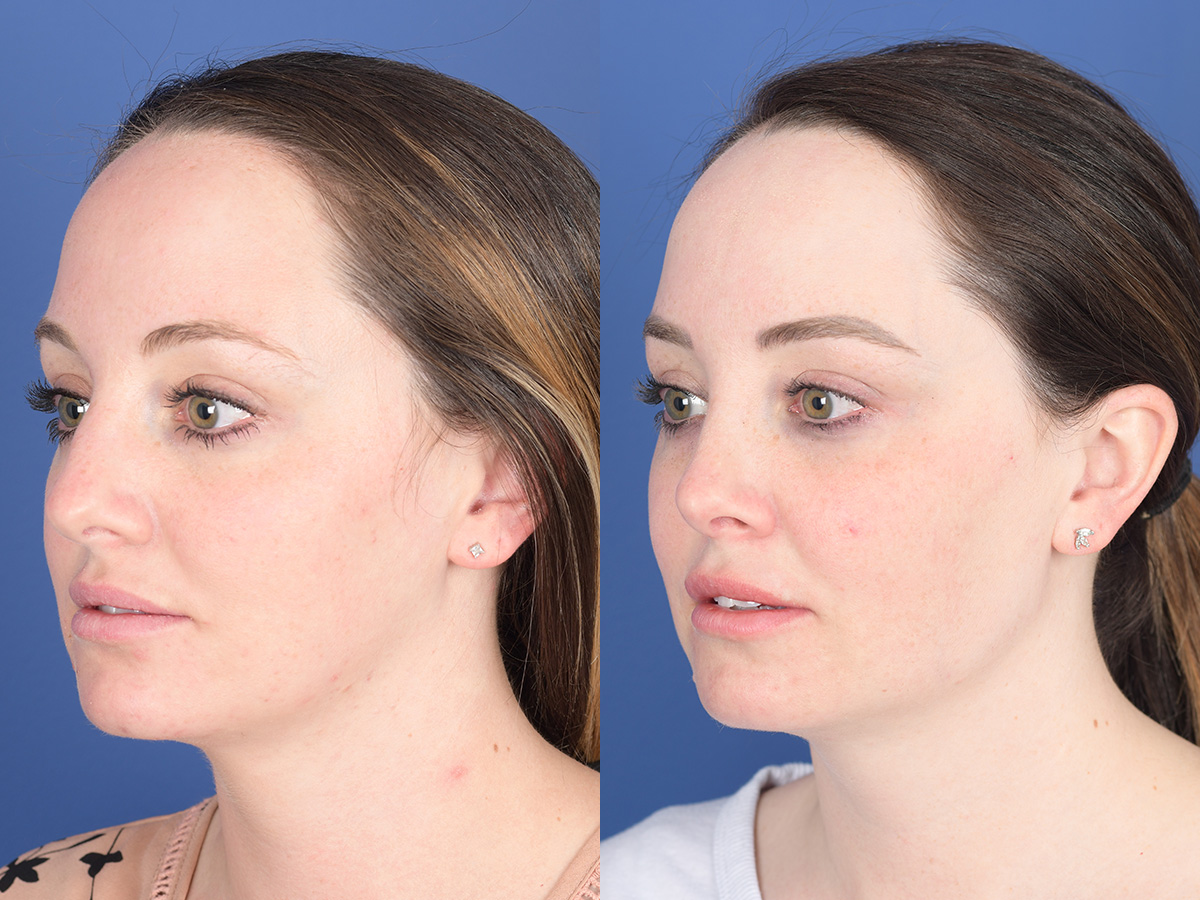 Rhinoplasty Before and After | Weber Facial Plastic Surgery