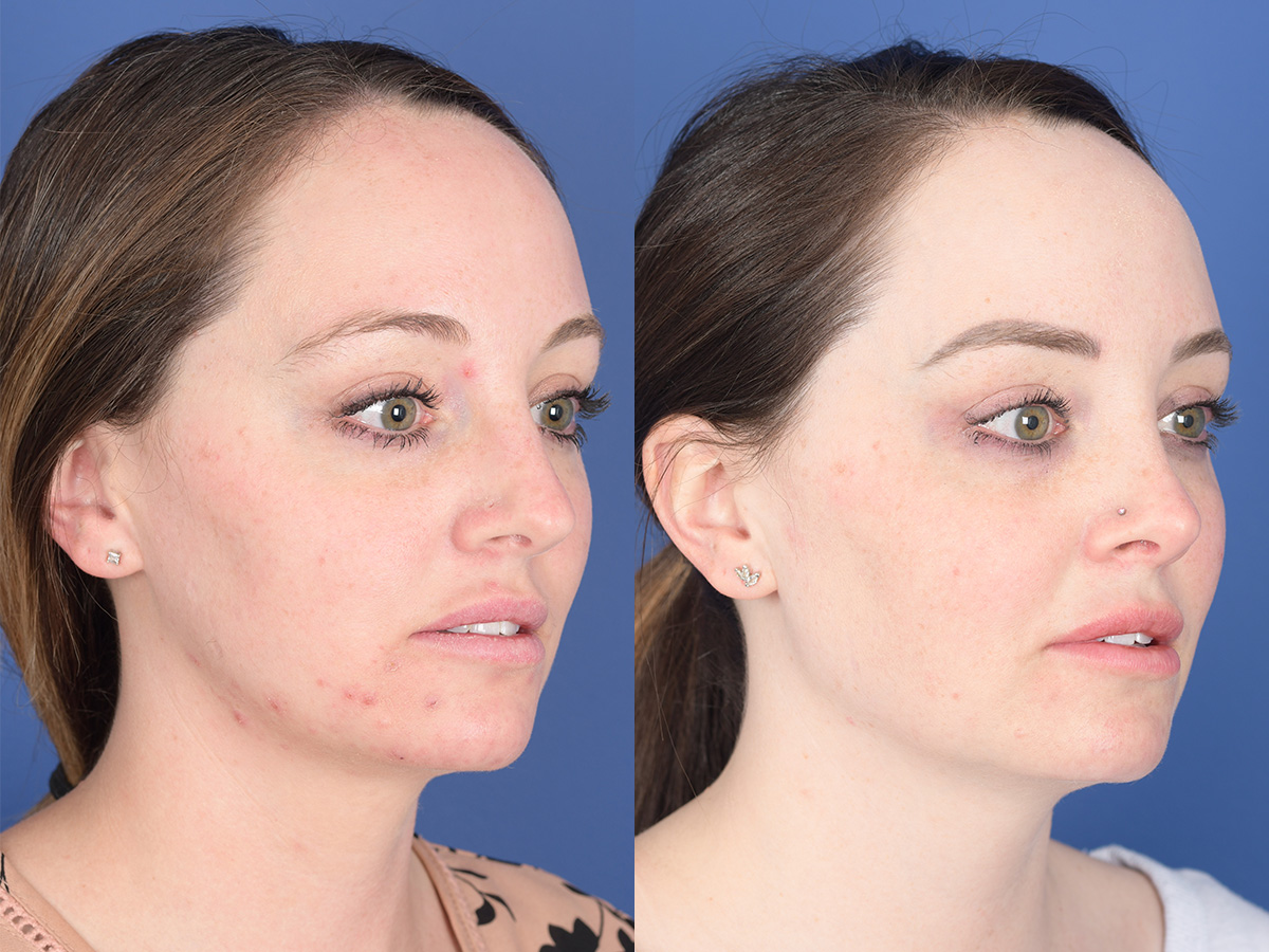 Rhinoplasty Before and After | Weber Facial Plastic Surgery