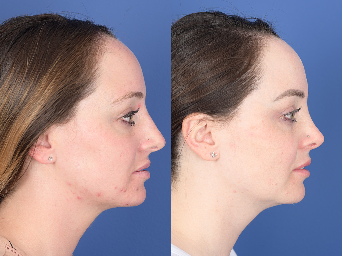 Rhinoplasty Before and After | Weber Facial Plastic Surgery