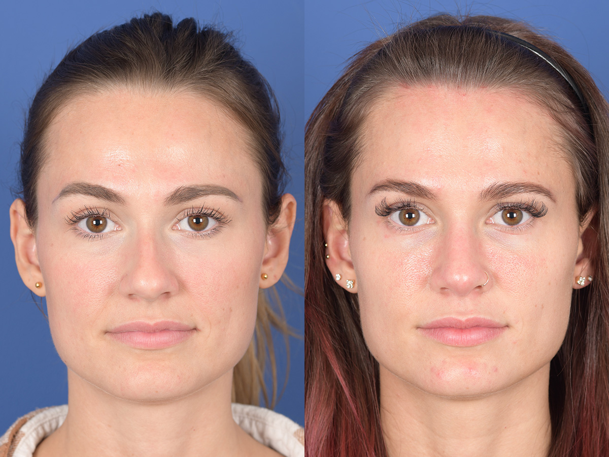 Rhinoplasty Before and After | Weber Facial Plastic Surgery