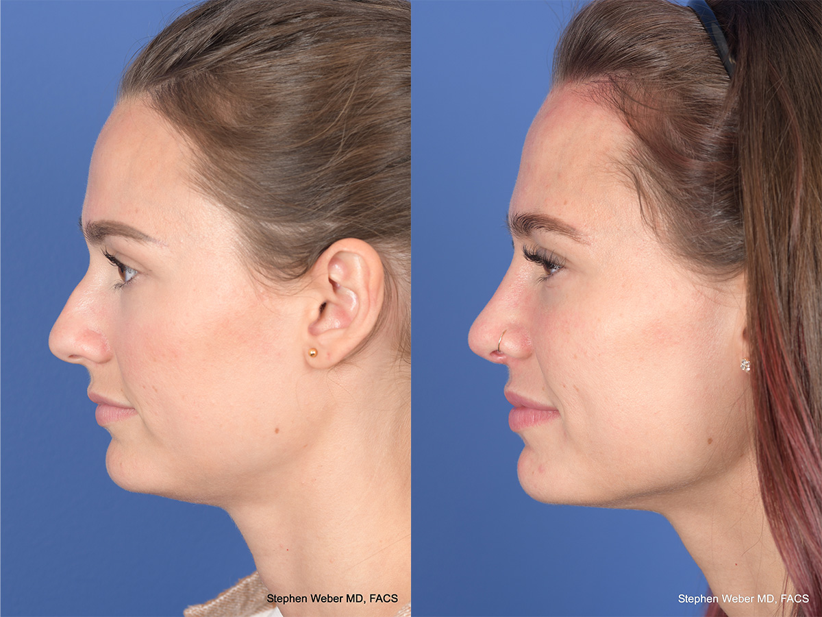 Rhinoplasty Before and After | Weber Facial Plastic Surgery